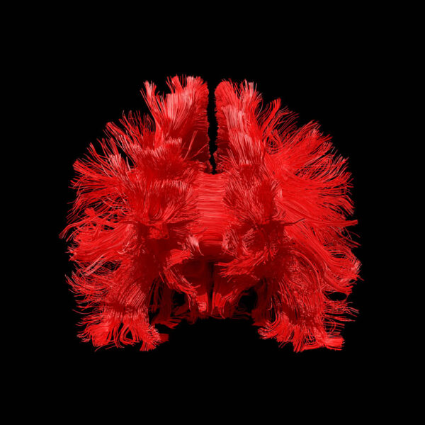 Frontal fibers in red on black